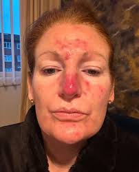 Abbey Hunt “Hello I just thought you might like to see my daughters results  from having horrendous chickenpox and using your green cream. Won't lie she  was a trooper though the whole