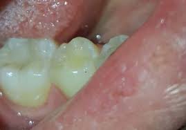 اﻟﺗﻘﻳﻳم اﻟﺳرﻳري واﻟﺷﻌﺎﻋﻲ ﻟﻣﺎدة Theracal LC ﻓﻲ اﻟﺗﻐطﻳﺔ اﻟﻠﺑﻳ