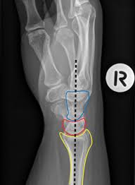 Image result for Wrist XRay
