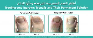 ‫الأظافر المغروسة المزعجة وحلها الدائم | Dubai Podiatry Centre‬‎