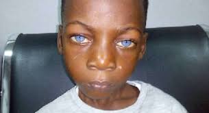Pdf Waardenburg Syndrome Type 2 A Report Of Three Cases In South West Nigeria Semantic Scholar