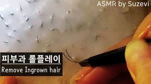 Ingrown hairs are individual strands that curl under the skin instead of rising straight from the follicle but dermatologists say they can be prevented if you tweak your routine when you shave or wax. Game Basketball Asmr Remove Ingrown Hair Dermatology Rp By Suzevi Whispering