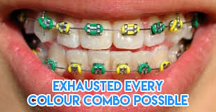 So if you do want colored braces they may cost more. 15 Must Knows About Braces For Potential Metalmouths To Survive The Next Two Years