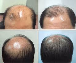 Head (top of head with back of neck) $2,299: Best Easy To Use Low Level Light Therapy For Hair Growth