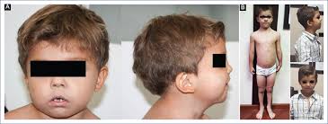 Robinow syndrome and its response to growth hormone treatment