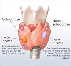 Die schilddrüsenszintigraphie ist eine nuklearmedizinische methode, die zur funktionsmorphologischen untersuchung der schilddrüse angewendet wird. Schilddrusenknoten
