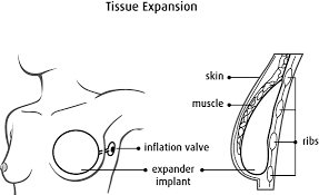 10 best breast implants of june 2021. Types Of Breast Reconstruction Canadian Cancer Society