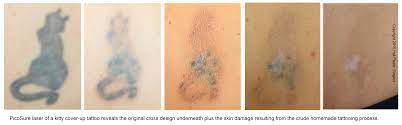 Find the relevant solution to your question. Picosure Laser Tattoo Removal Of A Cover Up Austinpicosure Com A Tattoo Removal Nurse S Notes