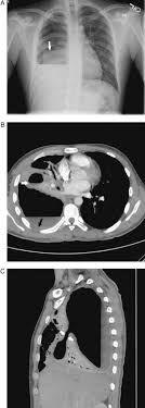 Most pleural effusions with large numbers of polymorphs are however, ct can help distinguish between a pleural effusion and a pleural empyema (see pleural strange or atypical configurations of pleural fluid can be due to either adhesions (i.e. Diagnostic Utility And Clinical Application Of Imaging For Pleural Space Infections Chest
