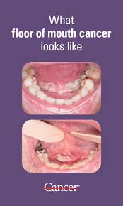 Image result for gum cancer symptoms