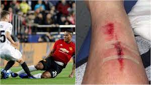 Jose mourinho insists antonio valencia's hamstring injury is 'normal'credit: Man Utd News Toni Lato Reveals Gruesome Injury From Antonio Valencia S Horror Tackle Metro News