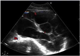 Learn about ovarian cancer symptoms, diagnosis, treatment, and more here. Hyperreactio Luteinalis Mimicking Malignancy During Pregnancy With Elevated Ca 125 Sciencedirect