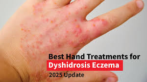 Image result for dyshidrosis