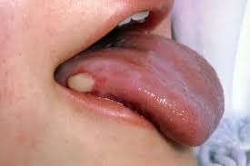 Image result for gum cancer symptoms