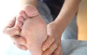 Athlete S Foot Causes Prevention And Treatment Harvard Health