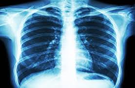This is the most common type. Mesothelioma And Pleural Disease Program Abramson Cancer Center Penn Medicine