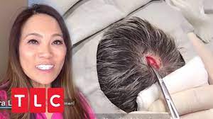Dr Sandra Lee Entfernt Atherom Vom Kopf Eines Patienten Dr Pimple Popper Tlc Deutschland Youtube