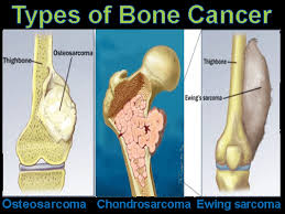Pin On Type Of Cancer