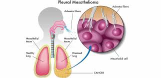 Glioblastoma is an aggressive cancer of the brain. Dr Bhavna Parikh Medium