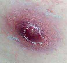 How To Make A Poultice For Removal Of Splinters Boils And Abscesses Home Remedy For Boils Boil Remedies Poultice For Boils