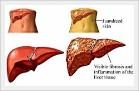 Pin Di Bahayanya Penyakit Liver Hati