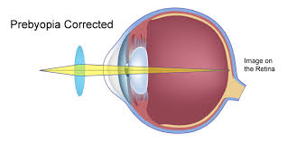 Image result for Presbyopia