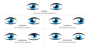 kingsway eye care vision therapy concussion learning