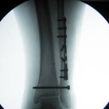 Posterior malleolus fracture component  9 , 10 , 11 . Lateral Malleolus Fracture S82 63xa 824 2 Eorif