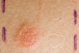 Image result for Patch Testing