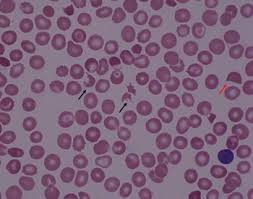 Image result for Peripheral Smear