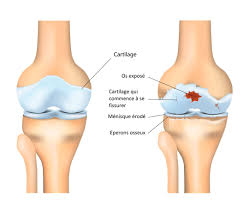 🔬💻 nous avons pour mission de modéliser l'articulation du genou. Cartilage Du Genou Abime Que Faire