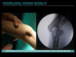 Image result for Pivot Shift Test