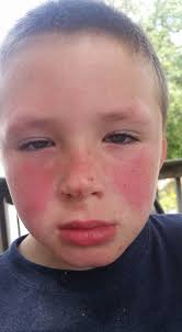 Very sad emotional mummy here....my little boy's been so unwell with up and  down fever especially worse at night. Loss of appetite but eating what he  can. Finally