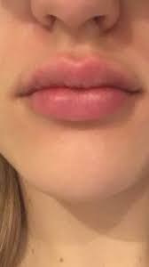 Lips are one of the main features that can make a face attractive. Bumps And Lumps After Lip Injections Should I Massage Them Out Photo