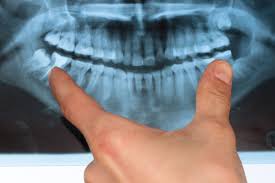 An unpleasant taste in your mouth 7. What You Should Know About Wisdom Teeth Complications And Removal