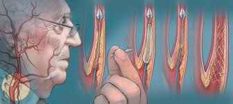 Image result for carotid artery