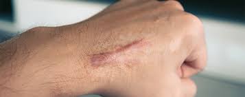 Why Is This Scar Still Bothering Me Understanding And Decreasing Scar Tissue Athletico