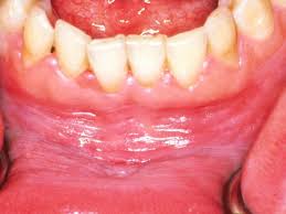 On the roof of your mouth is particularly bad as it can cause repeated infections at the base of your sinus. Bump On The Roof Of The Mouth 12 Causes