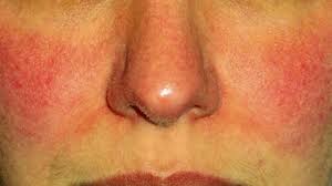 Here we'll guide you to the very best prices available today. Rosacea Types Causes And Remedies