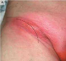 Read more below about what may be causing the lump in your groin and how your doctor may treat it. Preoperative Frontal View That Demonstrates A Red Round Bulge In The Download Scientific Diagram