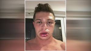 Same-sex couple recovering, exploring legal options after BK Whopper Bar  attack