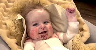 What Is Epidermolysis Bullosa? Rare Skin Disorder Explained