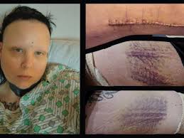 Fundraiser for Adam Stoner by Sharon Stoner-Hylton : Amputee Broken Femur  Family Needs Help