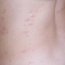 If you are fighting a massive flea infestation, you can spray the solution on your feet, arms, legs and other exposed areas of the body to deter flea bites. Flea Bites On Humans Symptoms Treatment And Prevention