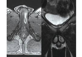 Image result for Priapism