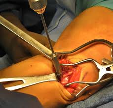 How does tommy john surgery affect position players, and is it right to assume they can recover more. Tommy John Surgery Ucl Reconstruction Doctor Khalfayan Seattle Wa