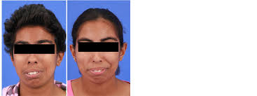 Ochoa Syndrome—A Twins Case Report