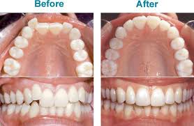 The pain may also be because of bicep tendonitis, a condition which happens due to repeated use of the bicep muscle. Menkeralign Custom Fabricated Clear Aligners Are Affordable And Work Fast To Give You Your Best Smile Invisalign Teeth Straightening Getting Braces