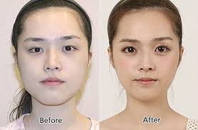 31 Crazy Before And After Photos Of Korean Plastic Surgery Korean Plastic Surgery Plastic Surgery Photos Cosmetic Surgery
