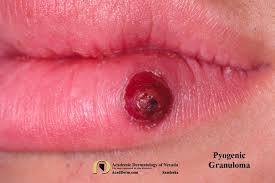 Image result for Pyogenic Granuloma